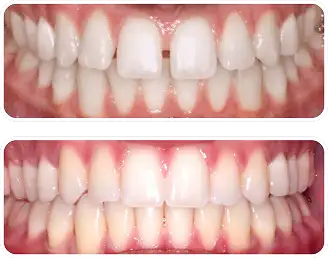 空隙歯列の一例