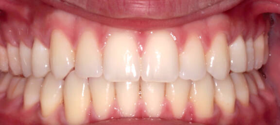 スペーシング After