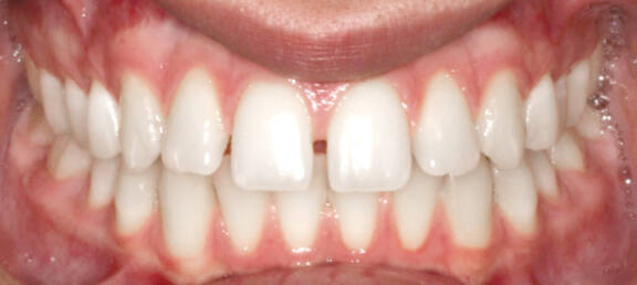 スペーシング Before